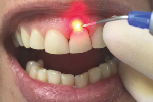 laser Odontologia
